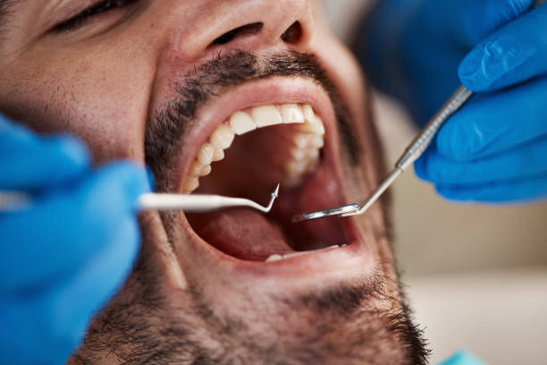 Best Emergency Dental Care for Broken or Chipped Teeth in Dupo, IL