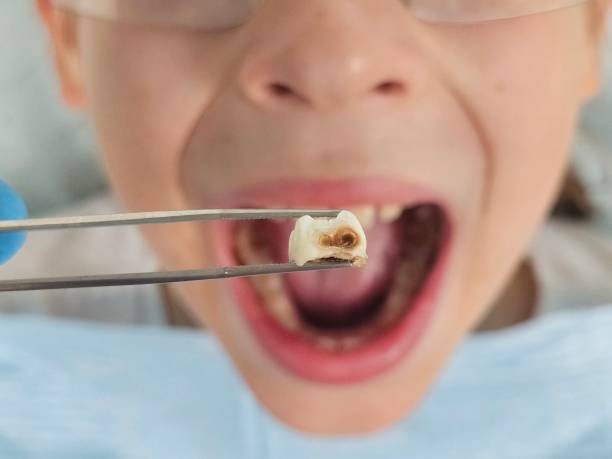 Best Emergency Dental Care for Broken or Chipped Teeth in Dupo, IL